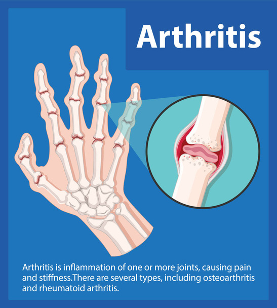 Aprender sobre las etapas de la artritis a través de una infografía de educación científica - Vector, Imagen