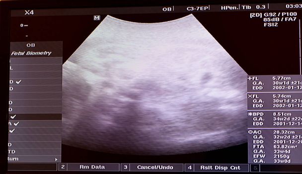 Echografie op de baarmoeder van een zwangere vrouw met een gezonde foetus, maternale echografie tijdens de zwangerschap, zwangerschapsopvolging en foetus gezondheidsconcept, medische controle van ultrasonogrammen - Foto, afbeelding