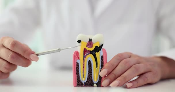 Denti con denti molto malati danneggiati e dentista. Carie e malattie gengivali - Filmati, video