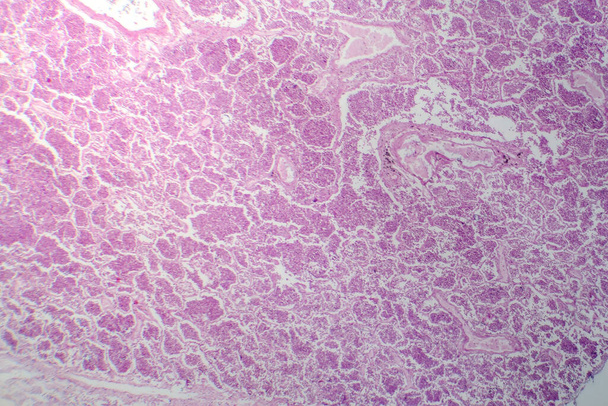 Gri hepatik evrede lobar zatürreenin fotomikrografı, akciğer dokusunda exüdate dolu alveolle geçiş olduğunu gösteriyor.. - Fotoğraf, Görsel