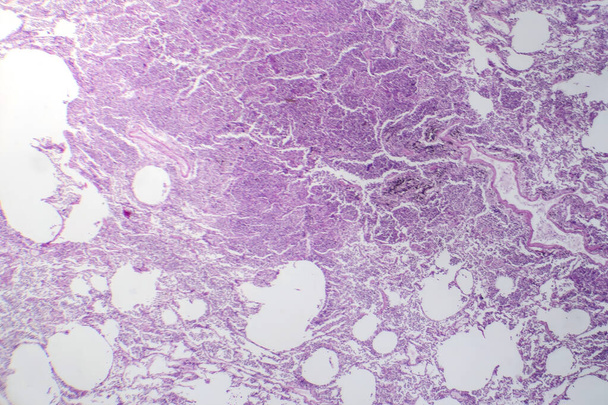 Photomicrograph of interstitial pneumonia, showing inflammation and fibrosis in the lung's interstitial tissue. - Photo, Image