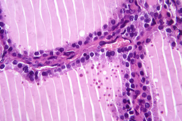 Φωτομικρογραφία δείγματος ιστού τοξικού βρογχοκήλη κάτω από μικροσκόπιο, αποκαλύπτοντας υπερτροφία των ωοθυλακικών κυττάρων του θυρεοειδούς, αυξημένη αγγείωση και εξάντληση κολλοειδών. - Φωτογραφία, εικόνα