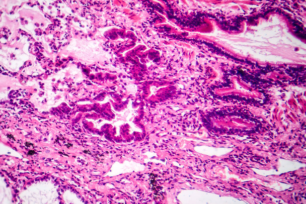 Akciğer adenokarsinomunun fotomikroskobu, en yaygın akciğer kanseri tipini gösteren kötü huylu salgı hücrelerini gösteriyor.. - Fotoğraf, Görsel