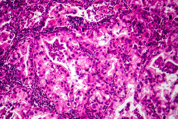 Akciğer kanseri dokusunun fotomikroskobu kötü huylu hücreleri ve akciğer hastalığının anormal büyüme özelliklerini ortaya çıkarıyor.. - Fotoğraf, Görsel