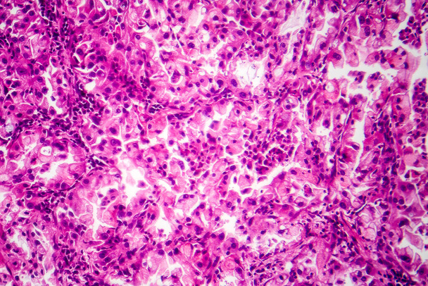 Fotomikrograf tkáně karcinomu plic, odhalující zhoubné buňky a abnormální růst charakteristický pro plicní malignitu. - Fotografie, Obrázek