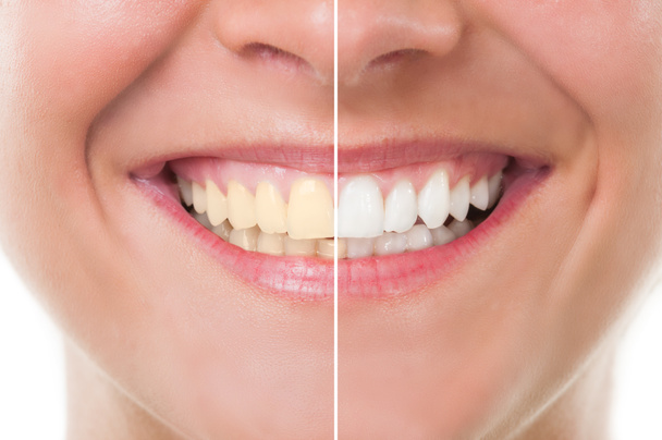 vor und nach der Zahnaufhellung - Foto, Bild