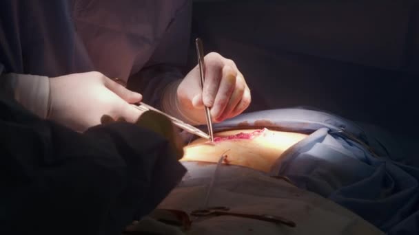Lähellä leikkausta. Ammatillinen kirurgi ompeleet leikattu käyttäen lääketieteen leikkeen ja pinsetit. Nuori sairaanhoitaja avustaa lääkintämiestä ja antaa lääketieteellisiä välineitä. Nykyaikaisessa terveyskeskuksessa työskentelevä hoitohenkilökunta. - Materiaali, video