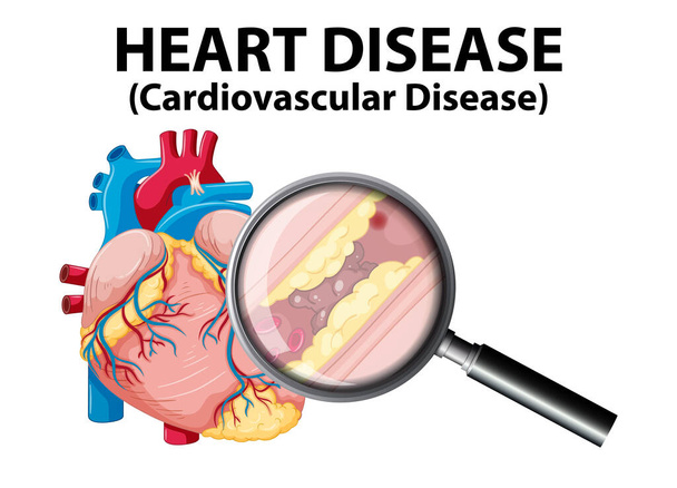Ilustrace zobrazující nemoci a srdeční choroby v lékařské infografii - Vektor, obrázek