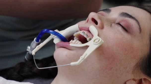 Крупним планом кавказька жінка при призначенні в стоматологічну клініку. Ортодонт фіксує лігатурні брекети на зубах клієнта. Концепція стоматології та ортодонтичного лікування - Кадри, відео