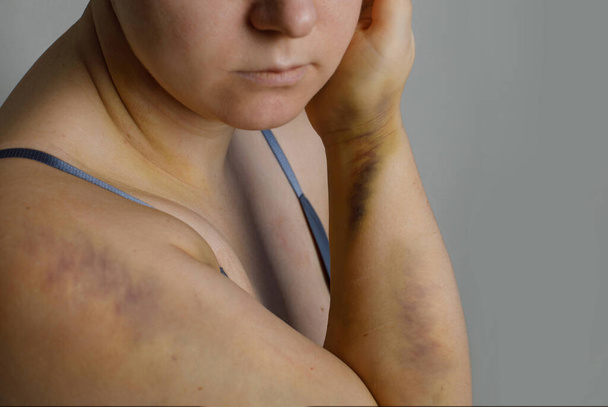 Le corps d'une femme avec des traces de violence. Bleus et abrasions. Le concept de liberté et de protection des femmes - Photo, image