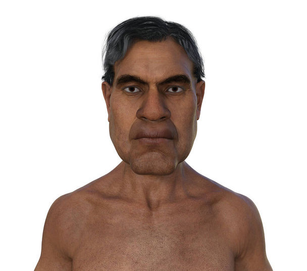 Акромегалия у человека, 3D иллюстрация, показывающая увеличение размера рук и лица из-за перепроизводства соматотрофина, вызванного опухолью гипофиза. - Фото, изображение
