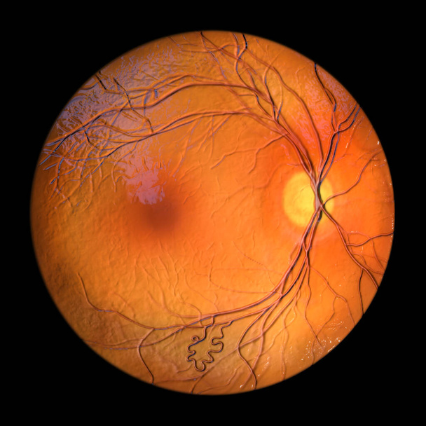 Retinalis arteriovenosus malformatio: Ritka veleszületett retinalis vascularis anomáliák kusza erek retina, 3D illusztráció mutatja artéria-véna kommunikáció beavatkozás nélkül kapillárisok. - Fotó, kép