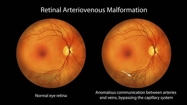 Retinale arteriovenöse Fehlbildung: Seltene angeborene retinale Gefäßanomalien mit verworrenen Blutgefäßen in der Netzhaut, Abbildung zeigt Kommunikation zwischen Arterie und Vene ohne intervenierende Kapillaren. - Foto, Bild