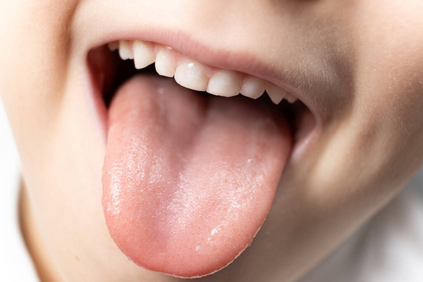 The tongue of a six-year-old healthy child, papillae on the tongue. - Photo, Image