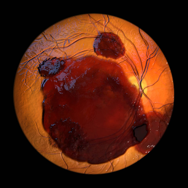 Медицинская 3D иллюстрация субретинального кровоизлияния, наблюдаемого во время офтальмоскопии, выявившего темное, неправильное кровоизлияние под слоями сетчатки. - Фото, изображение