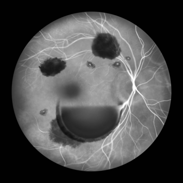 Ilustracja medyczna przedstawiająca zespół Tersona, ujawniająca krwotok wewnątrzgałkowy obserwowany podczas angiografii fluoresceiny, związany z krwotokiem wewnątrzczaszkowym lub urazem mózgu. - Zdjęcie, obraz