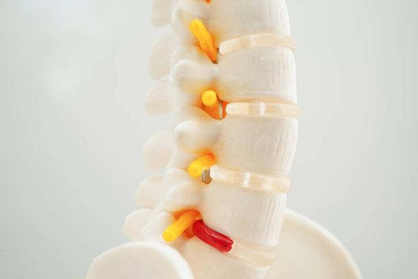 Spinale zenuw en bot, Lumbar wervelkolom verplaatst hernia schijffragment, Model voor de behandeling van medische in de orthopedische afdeling. - Foto, afbeelding