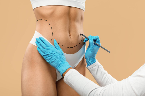 Lékař kreslení čára značky na ženské tělo před plastickou chirurgii operace, Nerozpoznatelná mladá žena ve spodním prádle Příprava na estetické Liposculpting léčba, Kreativní koláž - Fotografie, Obrázek