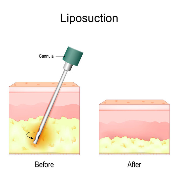 Liposuction prosedürü. Önce ve sonra. Yağ aldırma ve estetik ameliyat. Kilo kaybı için yağ aldırma. Vektör illüstrasyonu - Vektör, Görsel