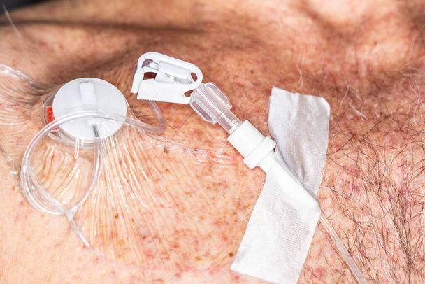 Schlauch mit Ventil und Gelenkanschluss für intravenöse Flüssigkeitsinjektionen an implantierbaren Port für Chemotherapie - Foto, Bild