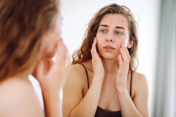 Skin problem. A beautiful woman touches her inflammation on her face while looking in the mirror in a bright room. Natural beauty. Medical care and treatment concept. - Foto, Bild