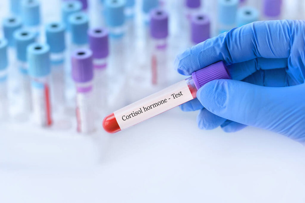 Lékař drží zkumavku vzorku krve s kortizol hormonální test na pozadí lékařských zkumavek s analýzami. - Fotografie, Obrázek