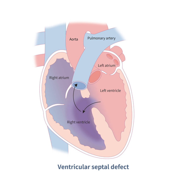 Ventriculair septumdefect is een van links naar rechts shunt op ventriculair niveau, en is ook een veel voorkomende aangeboren hart-en vaatziekten die kunnen leiden tot linker ventriculaire vergroting en hypertrofie. - Foto, afbeelding