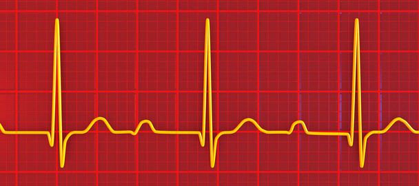 3D illustratie van een ECG met 1ste graads AV blok, een hartgeleidingsstoornis - Foto, afbeelding
