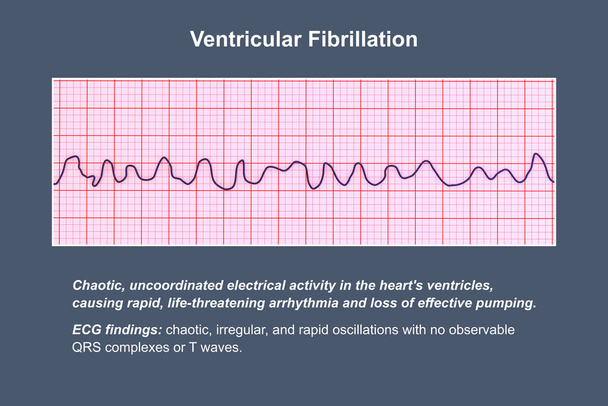 ЭКГ показывает хаотический ритм фибрилляции желудочков, угрожающую жизни сердечную аритмию, 3D иллюстрация. - Фото, изображение