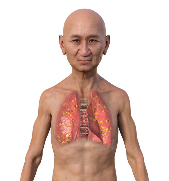 Человек с прозрачной кожей, выявляющий гистоплазмоз легких, грибковую инфекцию, вызванную капсулой Гистоплазмы. 3D иллюстрация, показывающая маленькие узелки, разбросанные по легким. - Фото, изображение