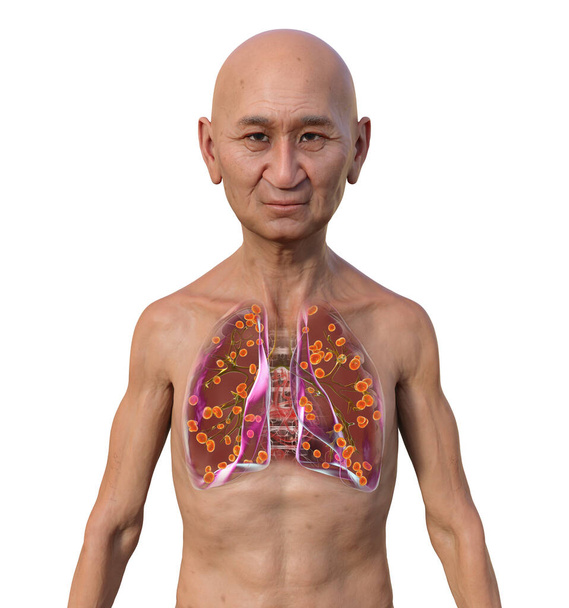 Чоловік з прозорою шкірою, що виявляє гістоплазмоз легень, грибкову інфекцію, спричинену капсулою гістоплазми. 3D ілюстрація, що показує невеликі вузли, розкидані по всій легені. - Фото, зображення