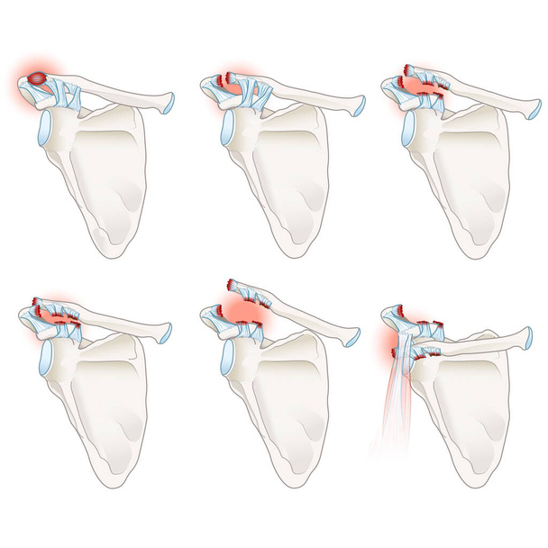 ACジョイント分離は,角膜関節の靭帯損傷を伴う肩の損傷である. それは痛み,腫れ,および可能な変形を引き起こし,保守的なアプローチから重度に基づく外科的介入に至るまでの治療オプション - 写真・画像