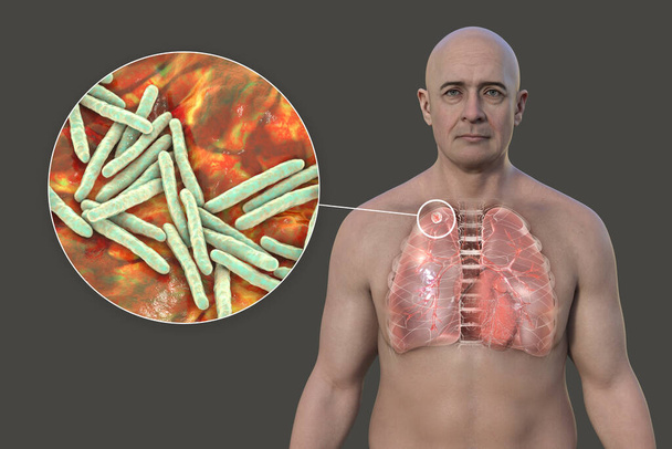 Ένας άνθρωπος με διαφανές δέρμα αποκαλύπτοντας τους πνεύμονες που επηρεάζονται από τη δευτερογενή φυματίωση και κοντινή θέα των βακτηρίων της φυματίωσης Mycobacterium, 3D εικονογράφηση. - Φωτογραφία, εικόνα