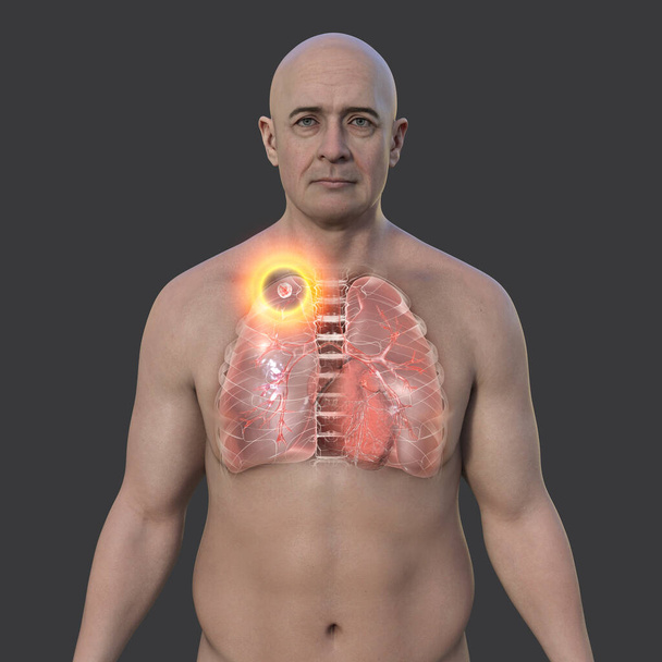 Muž s průhlednou kůží odhalující plíce postižené sekundární tuberkulózou, 3D ilustrace. - Fotografie, Obrázek