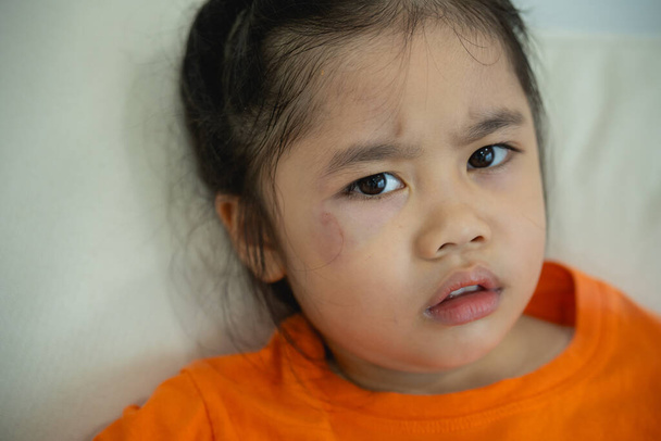 Portret Azjatki z siniakiem na prawym oku. Wypadki z dziecięcej zabawy. Przemoc wobec dzieci i kobiet. przemoc rodzinna. Pojęcie wykorzystywania fizycznego dzieci. - Zdjęcie, obraz