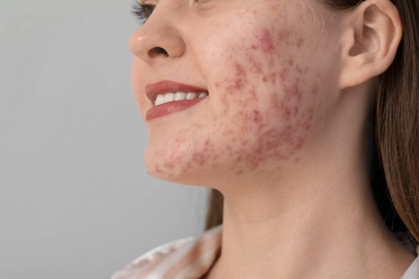 Young woman with acne problem on light background, closeup - Фото, изображение