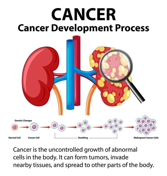 Illustrated infographic depicting the process of cancer development in the human kidney - Vector, Image