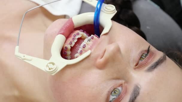 Close up de mulher caucasiana na consulta na clínica odontológica com aparelho de ligadura nos dentes. Correção ortodôntica da má oclusão. Conceito de tratamento ortodôntico e estomatologia - Filmagem, Vídeo