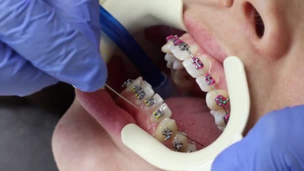 Ortodontista em luvas médicas instala um arco em aparelho de ligadura nos dentes do cliente. Conceito de tratamento odontológico para correção de má oclusão - Filmagem, Vídeo