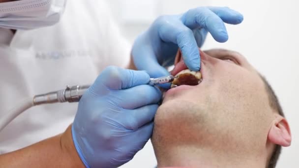 Professional teeth cleaning. Close up shot of doctor dentist making preventive deep cleaning procedure for male patient with perfect white smile at dental office, slow motion - Footage, Video