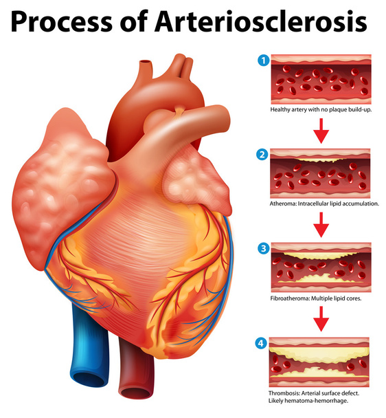 動脈硬化のプロセス - ベクター画像