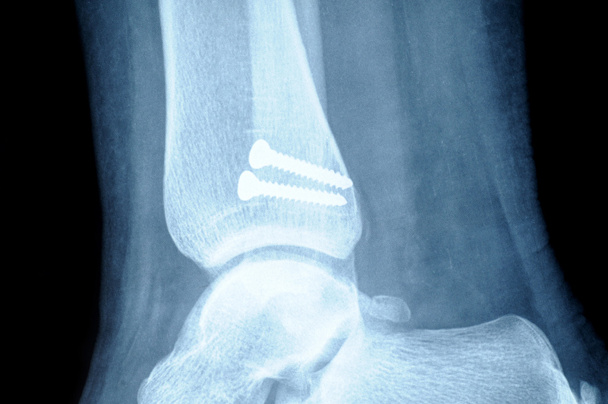 radiograph of human fracture fibula bone - Photo, Image
