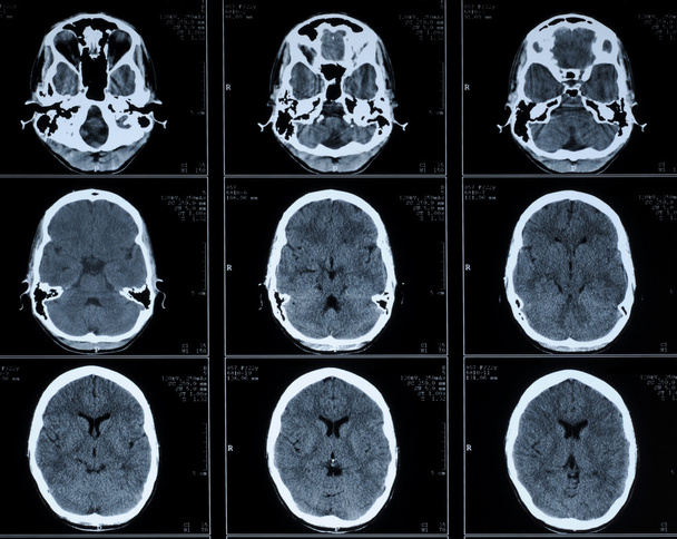 CT fotografii ludzkiego mózgu - Zdjęcie, obraz