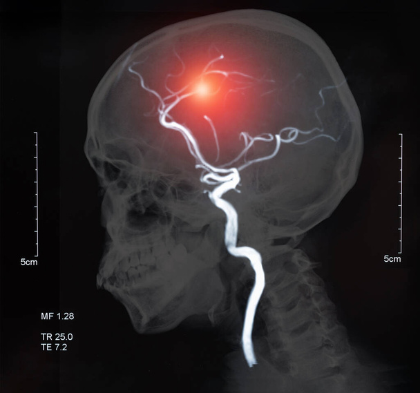 MRI of the blood vessels in the brain and cerebrovascular disease or or hemorrhagic stroke. brain stroke x-ray image. - Φωτογραφία, εικόνα