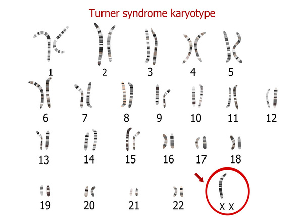 Turner syndrom karyotyp - Vektor, obrázek