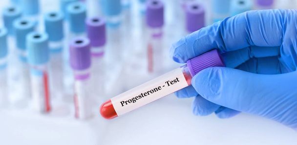 Médico sosteniendo un tubo de muestra de sangre de prueba con prueba de progesterona en el fondo de los tubos de prueba médica con análisis - Foto, imagen