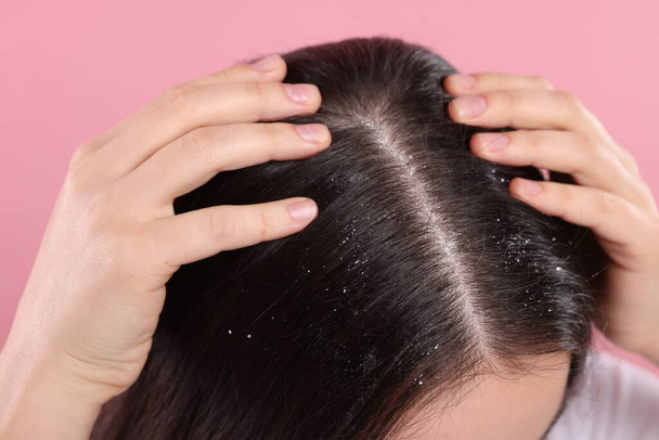Woman with dandruff problem on pink background, closeup - Foto, imagen