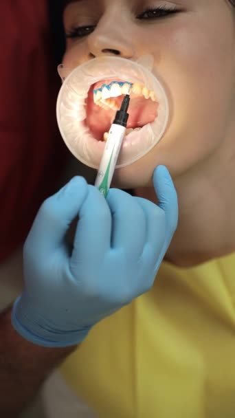 Detailní portrét pacientky u zubaře pro bělení zubů na klinice, bělení zubů. Svislé video - Záběry, video