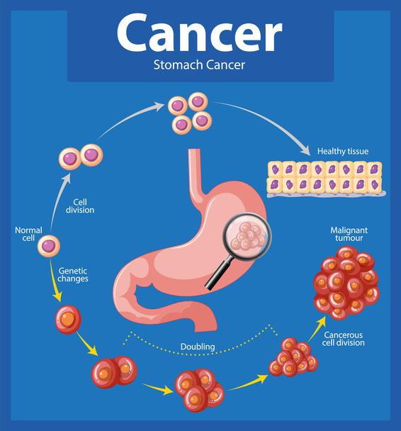Ilustrowana infografika przedstawiająca nieprawidłowy wzrost komórek w raku żołądka - Wektor, obraz