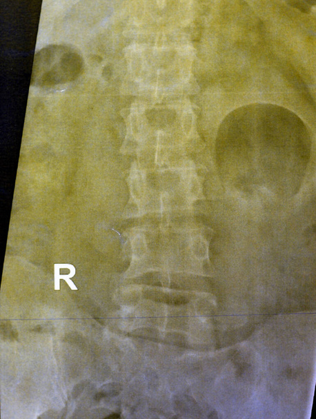 La columna lumbosacra de rayos X simples reveló deformidad escoliótica leve y enderezada de la columna vertebral, cambios espondilóticos, esacroilitis bilateral, estrechamiento leve de los espacios de disco L4-L5, L5- S1 - Foto, imagen